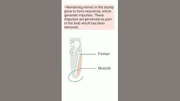Phantom Pain after amputation #shorts #physiotherapy