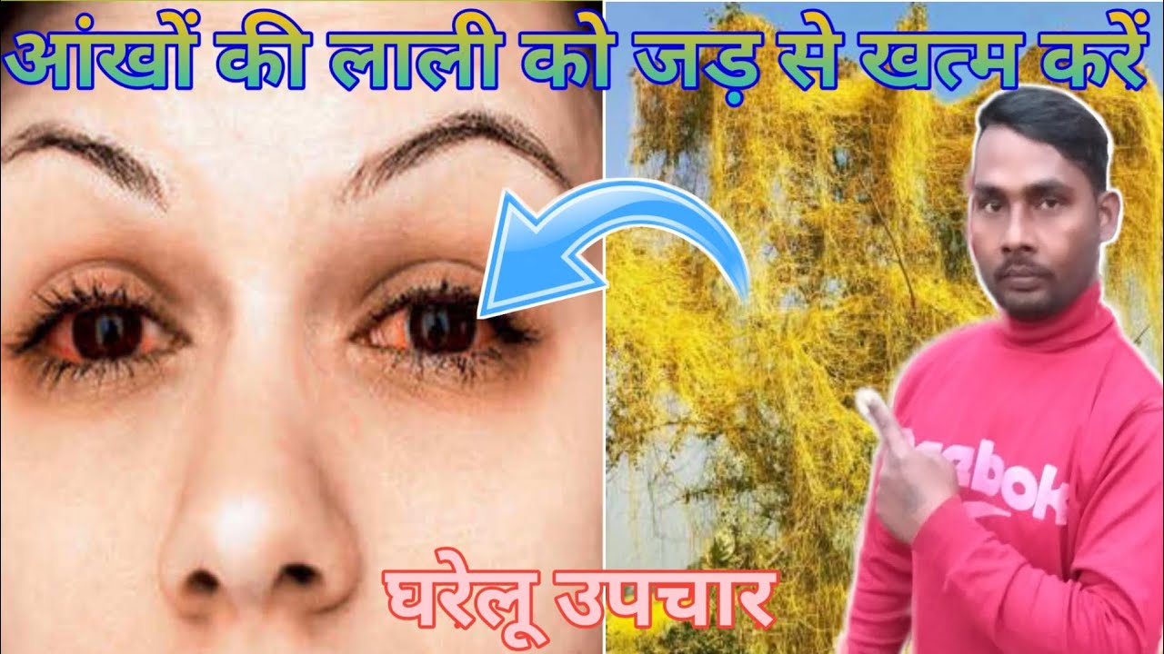 Eye Redness Causes and treatment आंखों की लाली को जड़ से खत्म करें