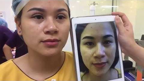 Kết Quả Cắt Mí Mắt Mani Mini Deep 5D Tại Dr.Hải Lê