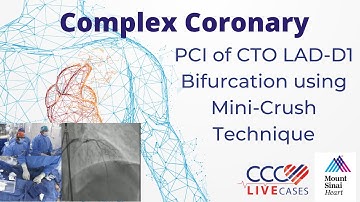 PCI of CTO LAD-D1 Bifurcation using Mini-Crush Technique