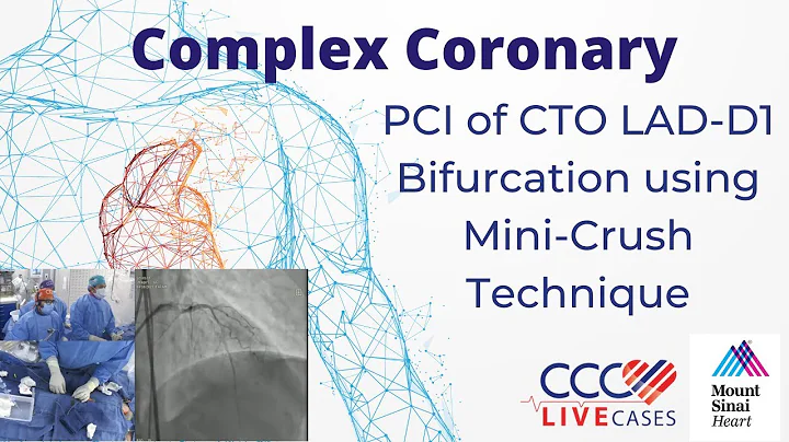 PCI of CTO LAD-D1 Bifurcation using Mini-Crush Technique