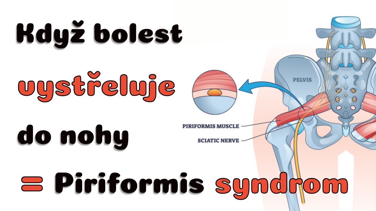 Když bolest vystřeluje ze zad přes zadek do nohy - Piriformis syndrom | Lukáš Vaníček