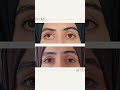 دكتور اديب عقراوي تجميل Eyes تيك توك اكسبلور Art حول 