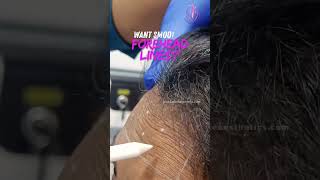 Botox Treatment in Bangalore | Pink Apple Aesthetics