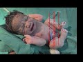Moro Reflex Explained in 30 Seconds