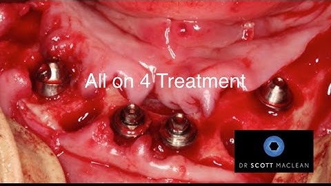 All on 4 Bridge Insert - DENTAL IMPLANTS