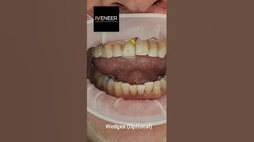 Try In and setting IVENEER