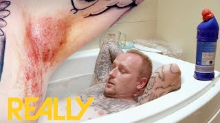 Man Has To Bathe In Bleach To Treat Blisters In The Groin The Bad Skin Clinic