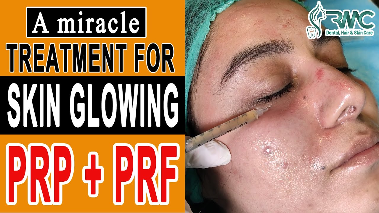 Skin Glowing Treatment Face PRP Plus PRF Dermatologist Rehman