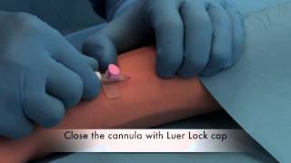 Delta Med Safety Cannula Training Video