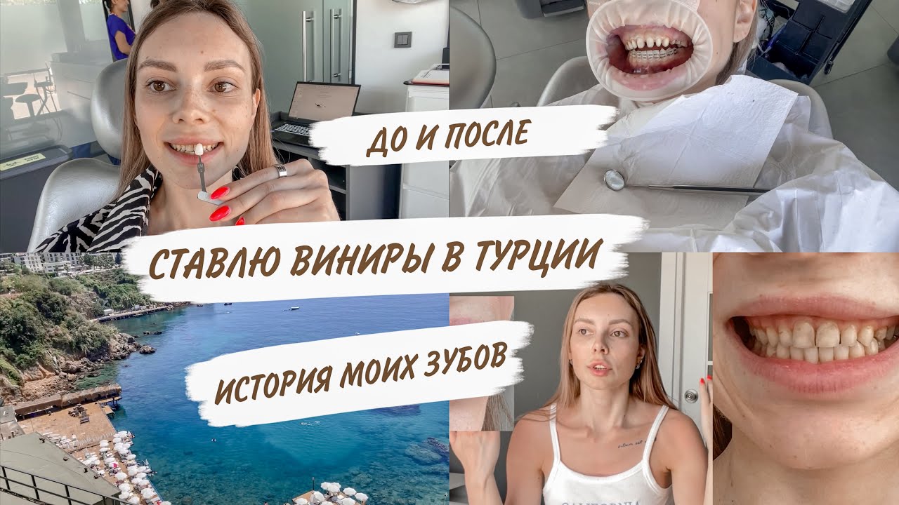 СТАВЛЮ ВИНИРЫ В smile team turkey 😳МОЙ ОПЫТ |ИСТОРИЯ МОИХ ЗУБОВ | ДО И ПОСЛЕ 🦷ВИНИРЫ И КОРОНКИ