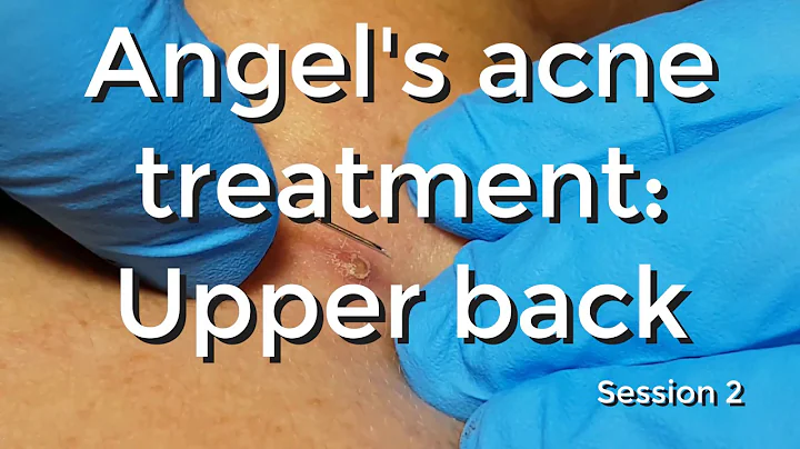 Angel's Acne Treatment: Upperback - Session #2 - DayDayNews
