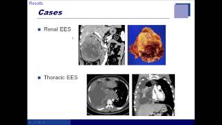 [Listen to Authors] Imaging Features of Extraskeletal Ewing Sarcoma