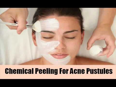 6 Treatments For Acne Pustules