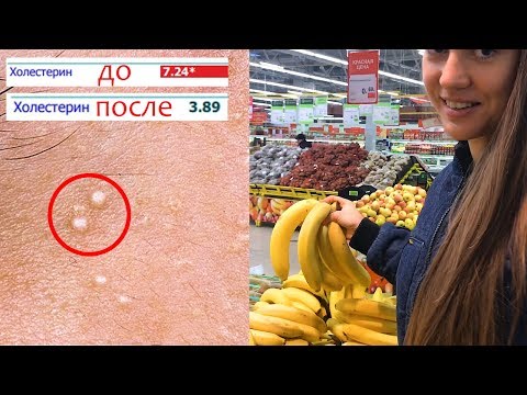 Косточки на ногах лечение причины и симптомы