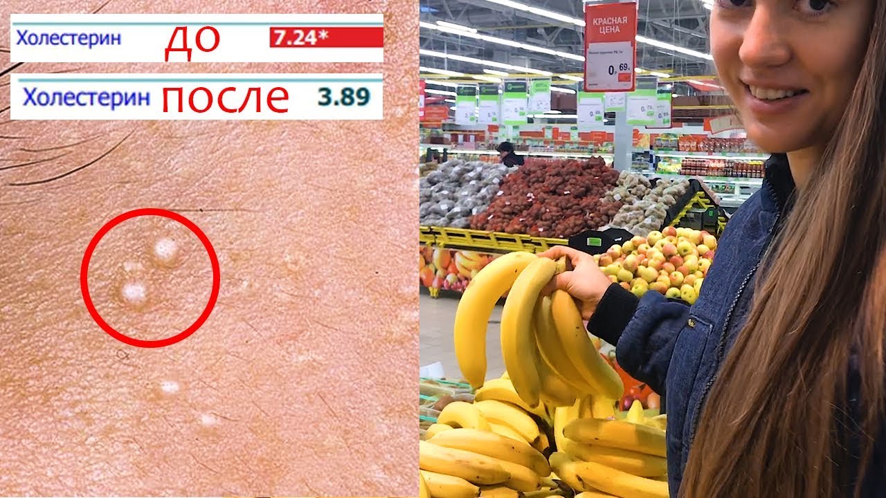 БЕЛЫЕ ПРЫЩИ, ЖИРОВИКИ НА ЛИЦЕ 😱 Как я снизила холестерин в крови без лекарств 🌴 POLI NA PALME