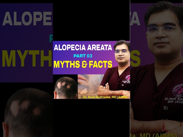 Alopecia areata myth or fact | Alopecia Treatment | Bald Spots | Dr Sunil Kothiwala