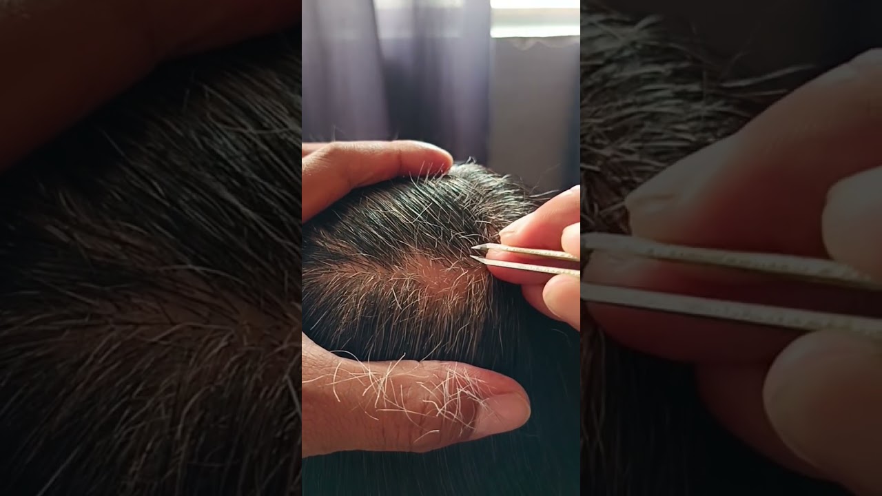 Most satisfying white hair removal1. 25#relaxing #satisfying #stressremoval 