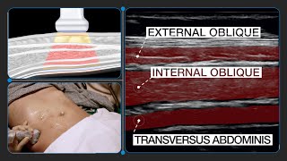 How to Correctly Identify Anatomy for Transversus Abdominis Plane (TAP) Block