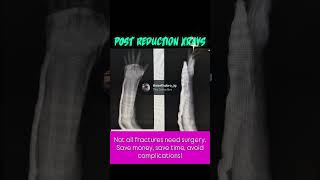 Closed reduction and cast immobilzation of radius ulna fracture. #trauma #fracture #fracturerepair