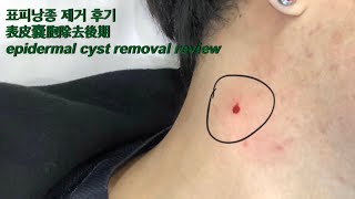 표피낭종 제거 후기 表皮嚢胞除去後期 epidermal cyst removal review