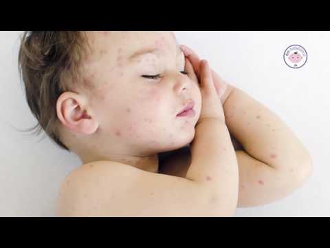Video: Ospice, Vodene Kozice, Rubeola I Druge Zarazne Bolesti Kod Djeteta
