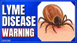 Lyme Disease: Symptoms You Must Never Ignore | Doctor Explains