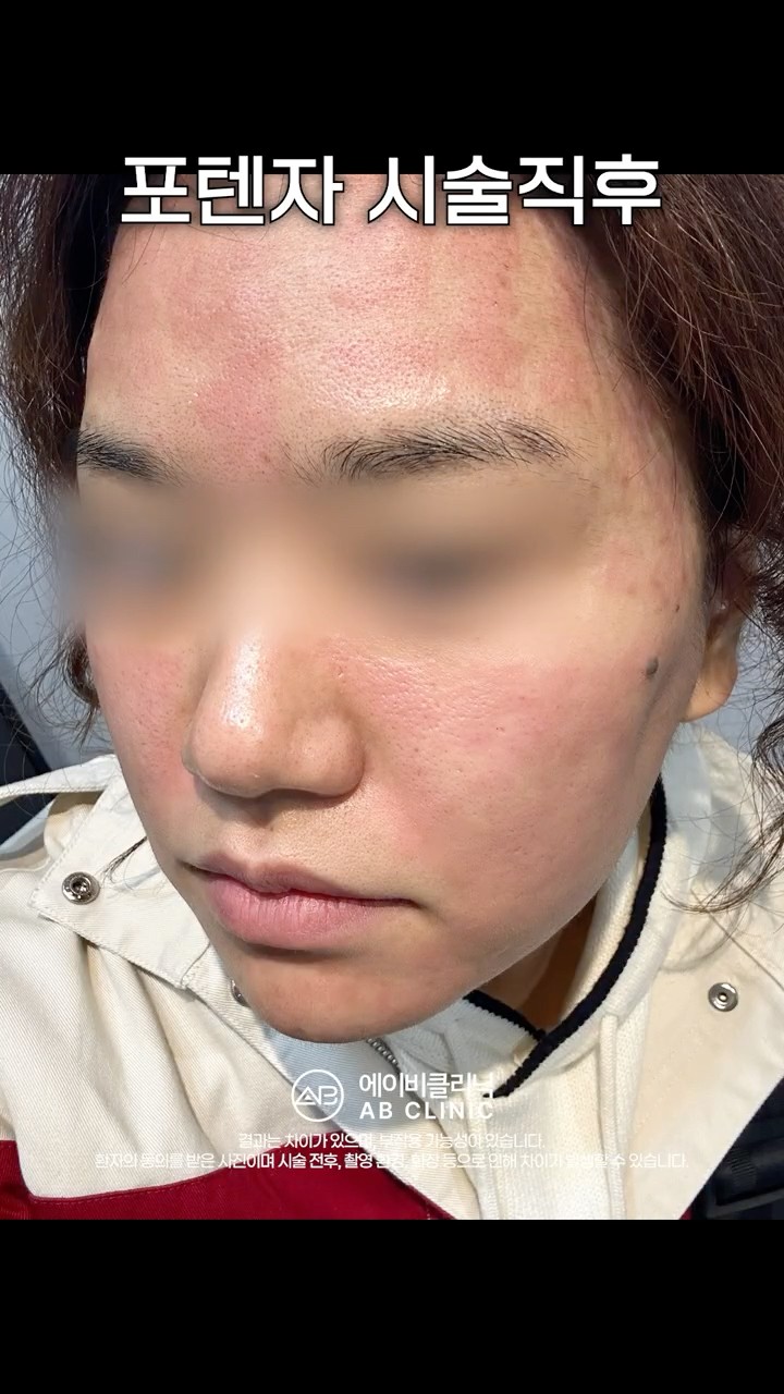 포텐자 시술 후 변화