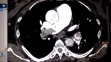 Ct pulmonary angiography
