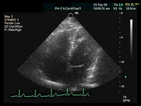 Apical Trabeculation - YouTube