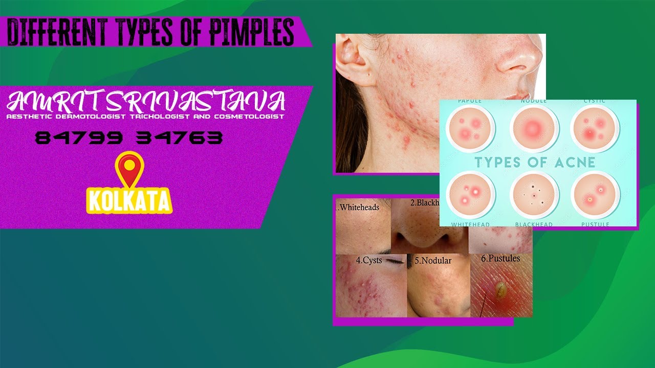 Types of PIMPLES/Whiteheads blackhead papules pustules cyst and nodular pimples/Dr AMRIT SRIVASTAVA