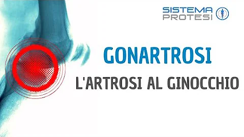 Cos'è la sclerosi dei piatti tibiali?