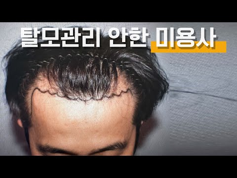 더 빠지면 끝장난다? 청담동 원장이 꼭 지키는 탈모 예방 루틴 5가지