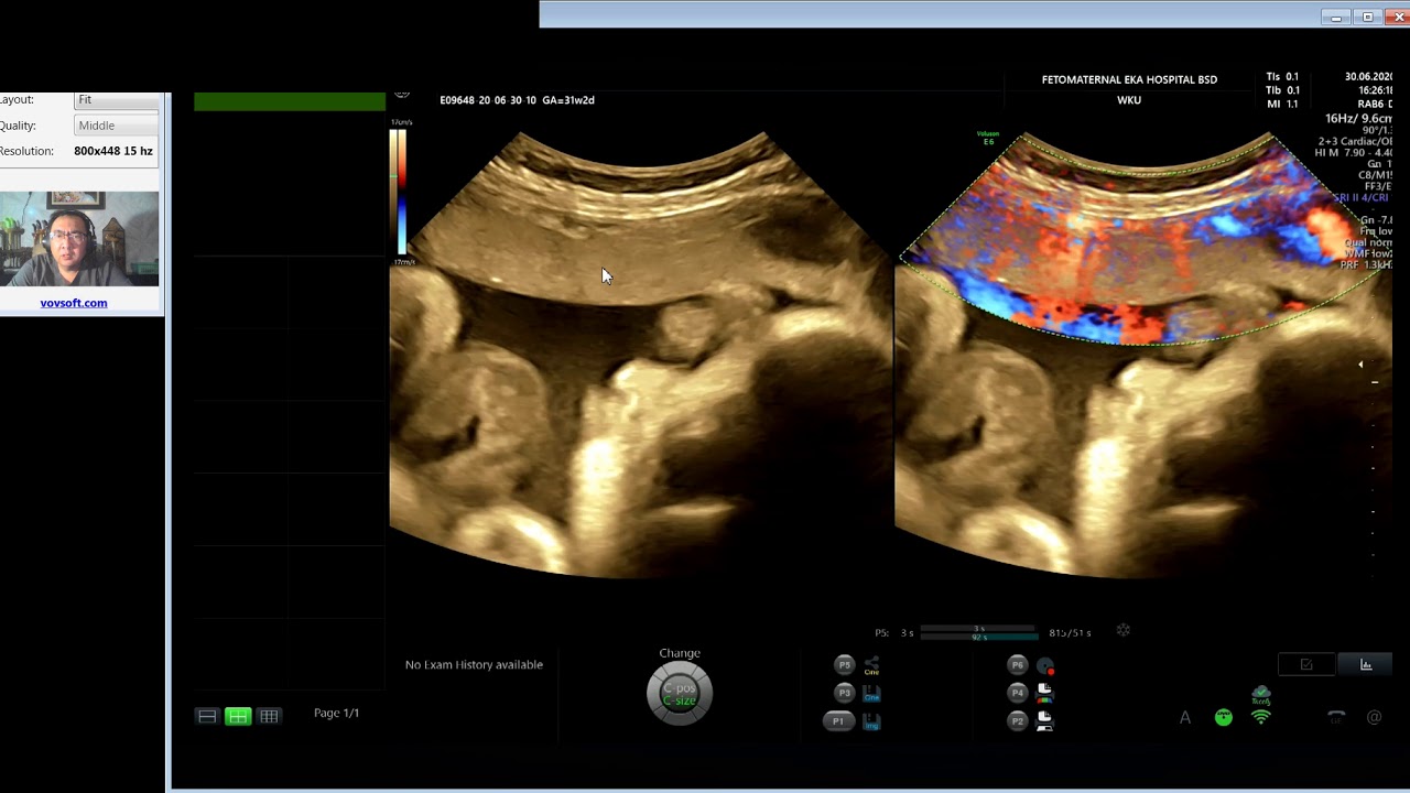 PLASENTA ACCRETA PADA BEKAS OPERASI SESAR (Dr. Wiku Andonotopo)