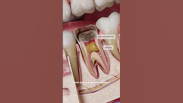 What are denticles and how do they affect endodontic treatment? 3D visualization with VOKA