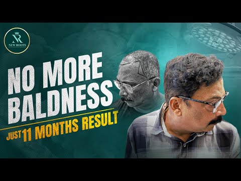 From Grade 5 Baldness to THIS! 🤯 | Best Hair Transplant Result in Nagpur | New Roots