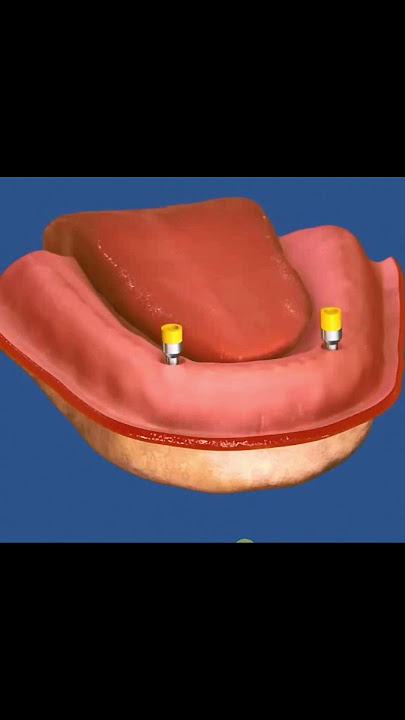 How do snap in dentures work ?