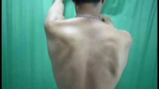 scapulothoracic dyskinesia Abnormal scapulothoracic motion Dr.Bancha Chernchujit