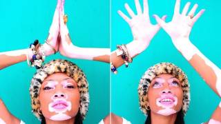 Vitiligo: A Skin Condition not a Life Changer