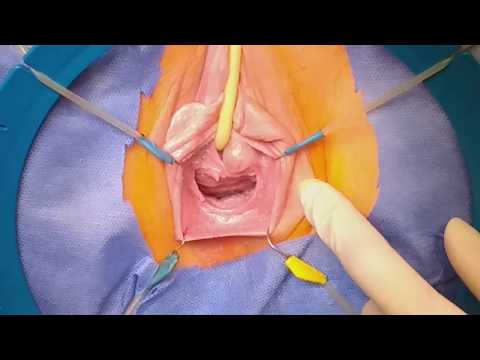 Vídeo: Divertículo Uretral: Tratamiento, Cirugía Y Recuperación