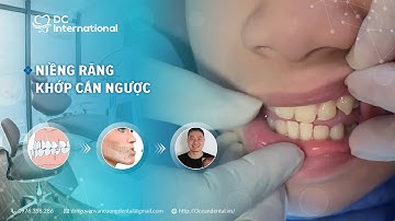 Niềng răng khớp cắn ngược! Dr Cường