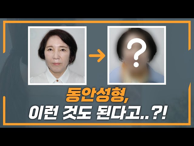 중년 동안성형, 이런 것까지도 가능합니다👌🏻
