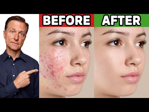 The Best Trick for Clear Skin (Acne, Aging, Wrinkles, Liver Spots)