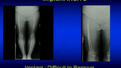 introducing nagivation in  TKR Evolutionary Change By Dr vivek mahajan
