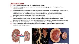 картинка: УЗИ. Доктор Иогансен. Выпуск 70. Аномалии развития почек и мочеточников. Часть 2.