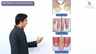 Raynaud's phenomenon - Raynaud's disease & Raynaud's syndrome