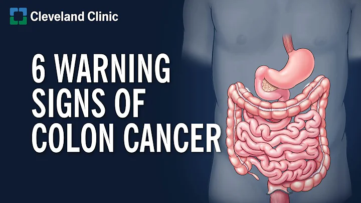 6 Warning Signs of Colon Cancer - DayDayNews