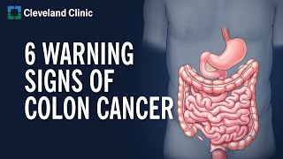 Colon Cancer: Symptoms, Stages & Treatment