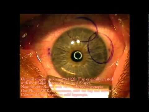 LASIK enhancement with epithelial cells growing under flap