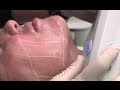 Ultherapy Non Invasive Skin Tightening with Cosmetic Surgeon Dr. George Davis